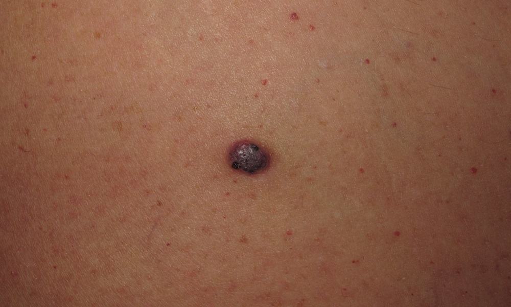 Prevenir lunares rojos