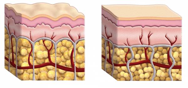 Celulitis Piel