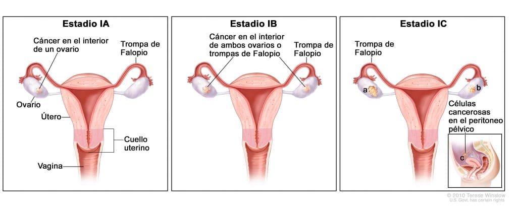 etapas del cáncer de ovario