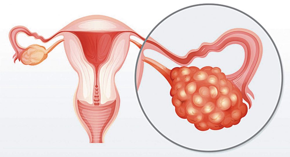 cáncer de ovario