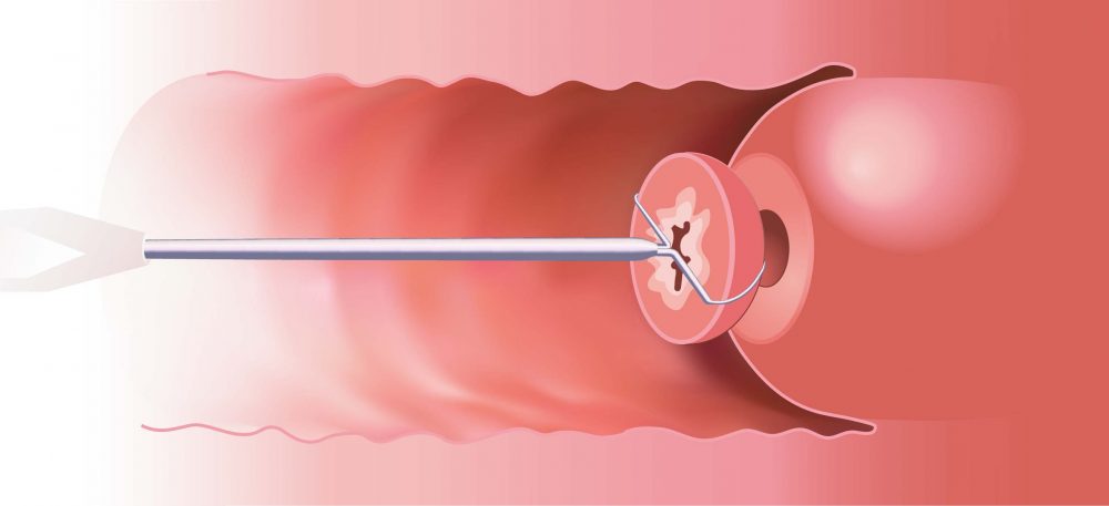 Tratamientos para células precancerígenas de VPH, conización