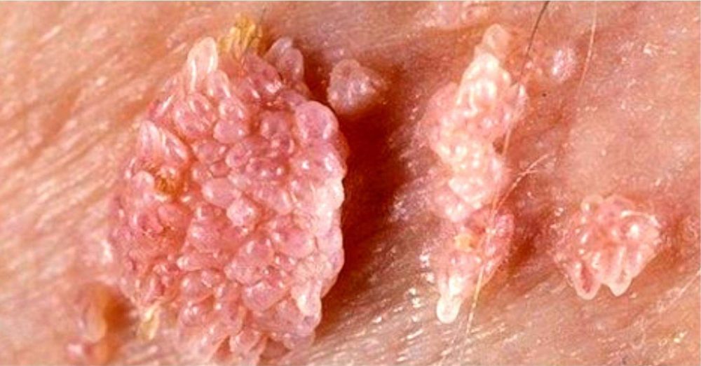 berrugas vph o virus del papiloma humano