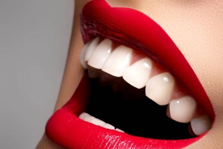 carillas dentales