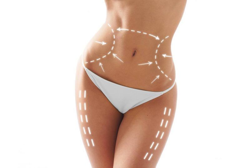 todo sobre la liposucción