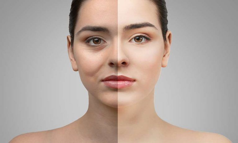 Cirugía Blefaroplastia