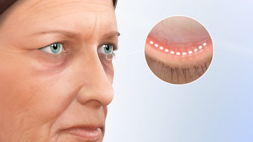 Cirugía de párpados o blefaroplastia
