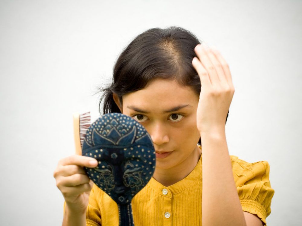 alopecia en mujeres