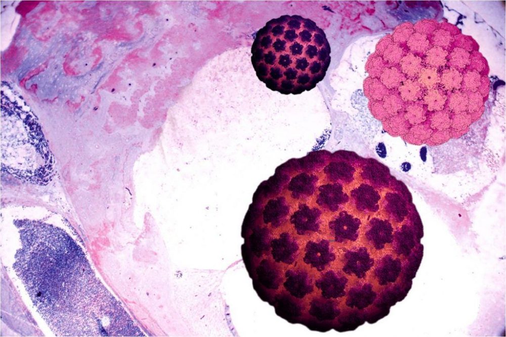 tratamientos para cáncer de cérvix