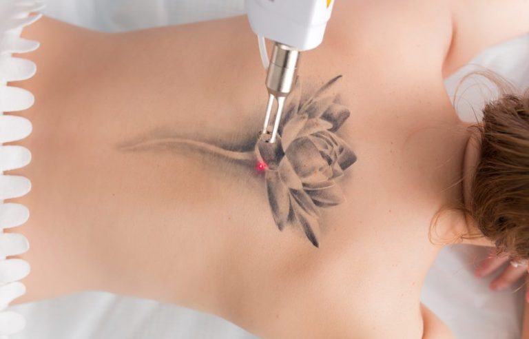 Cómo se eliminan los tatuajes