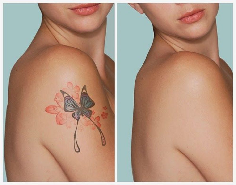 Se necesitan varias sesiones de láser para eliminar un tatuaje