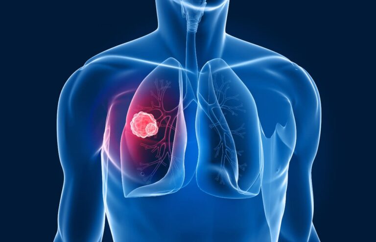 cáncer de pulmón: diagnóstico y tratamiento