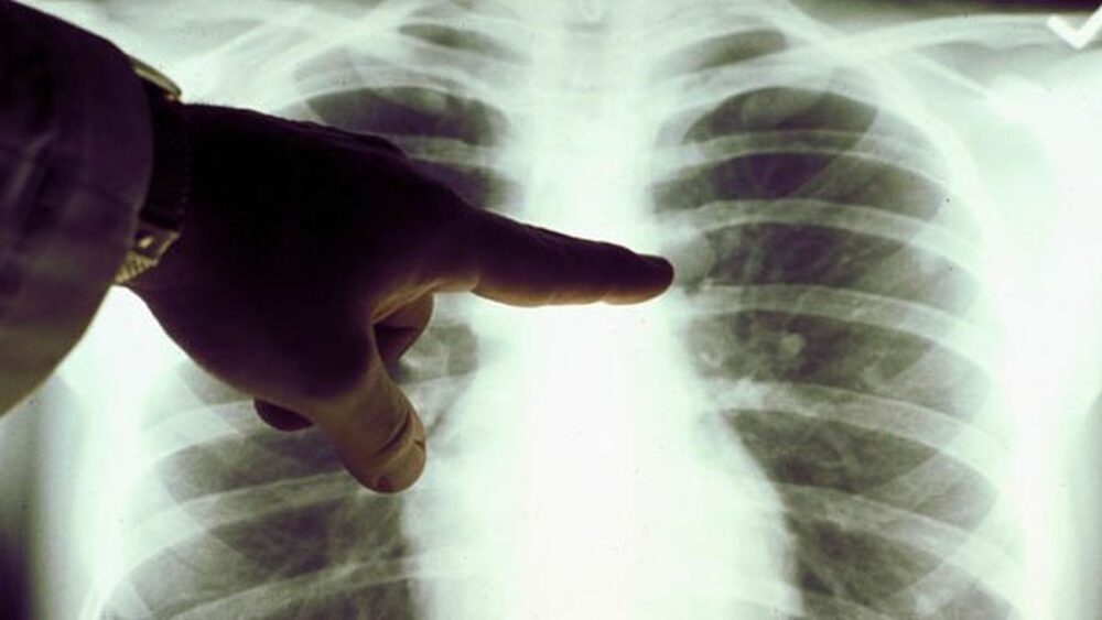 Síntomas del cáncer de pulmón