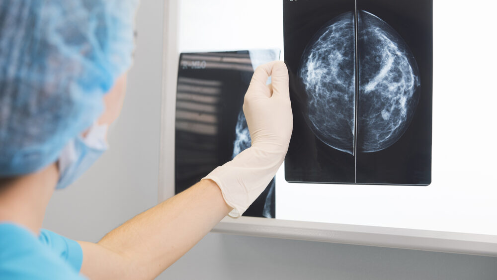 Cáncer de mama