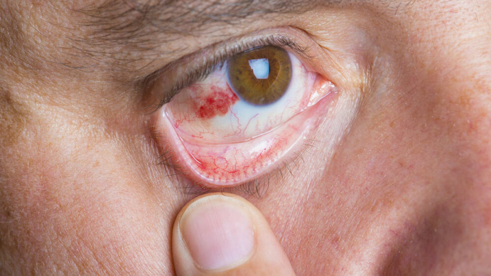 Causas derrames oculares o por qué aparecen manchas rojas en los ojos