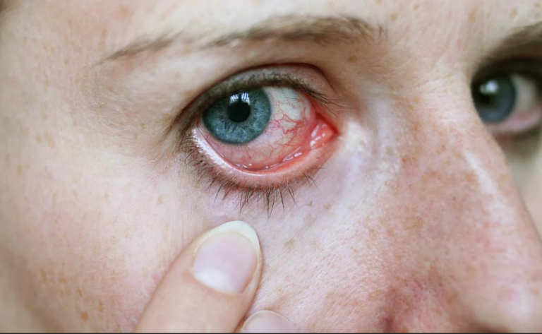 manchas rojas en el ojo