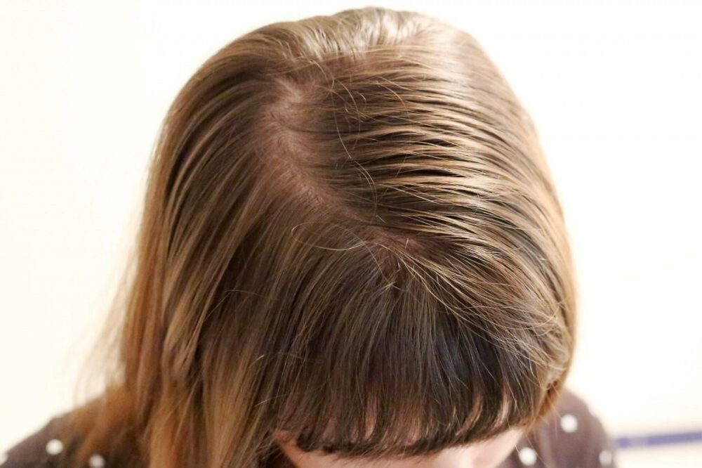 controlar el cabello graso