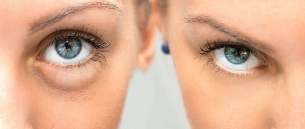 ojeras y bolsas en los ojos