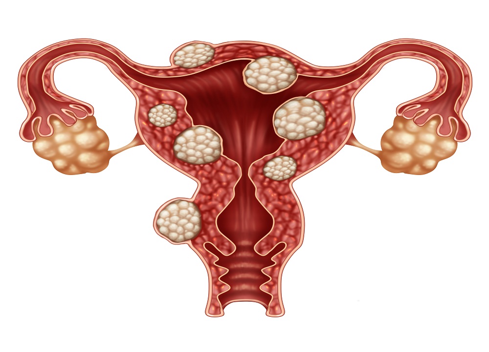 Miomas en el útero