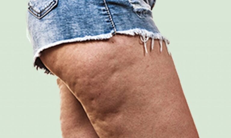 evitar la celulitis