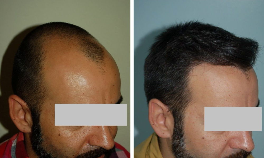 Injerto capilar en hombre