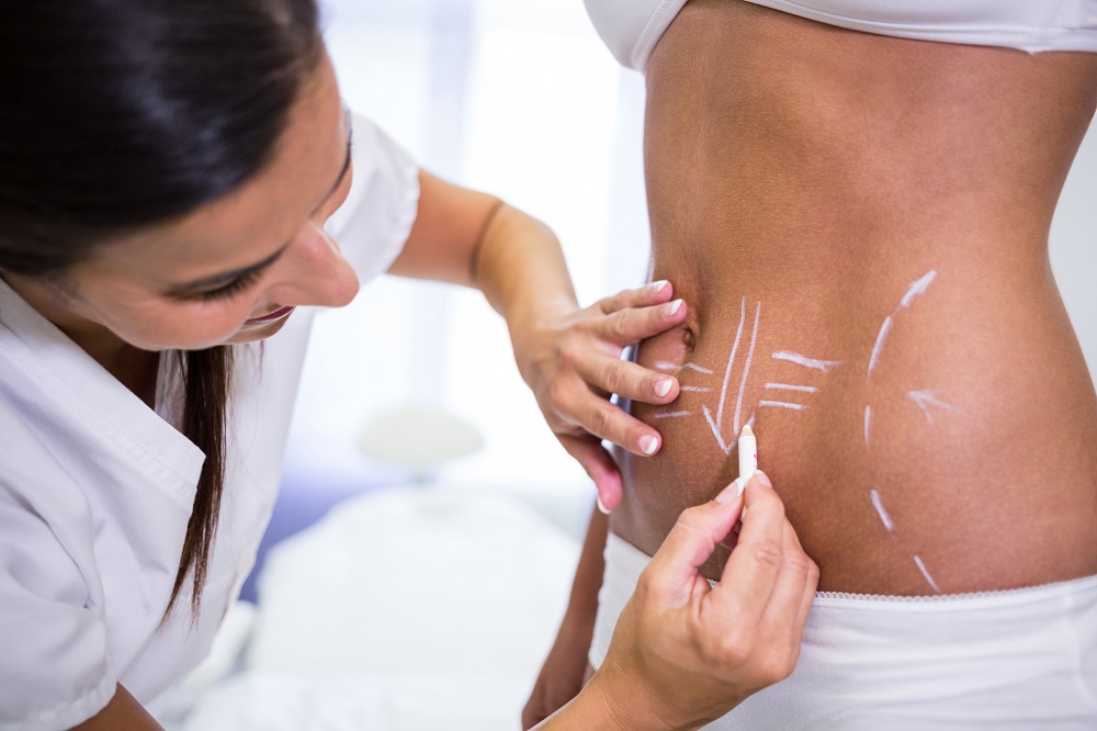 Una de las diferencias entre la liposucción y la abdominoplastia es que esta última solo se hace en el abdomen, mientras que la liposucción puede hacerse en la cara