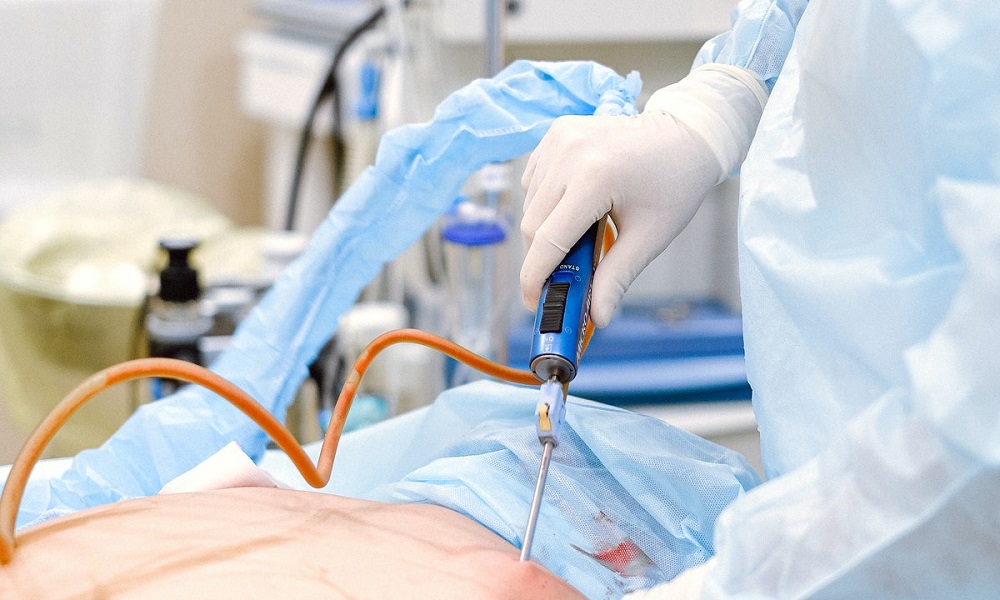 La liposucción es ambulatoria