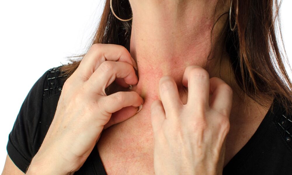 La dermatitis atópica puede aparecer por factores genéticos