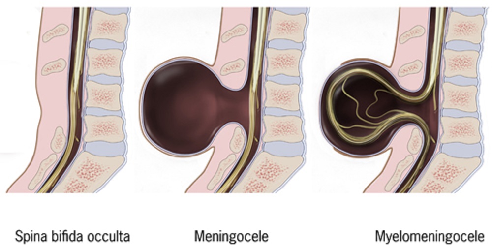 Entre las malformaciones de la columna vertebral,la espina bífida oculta es el más leve