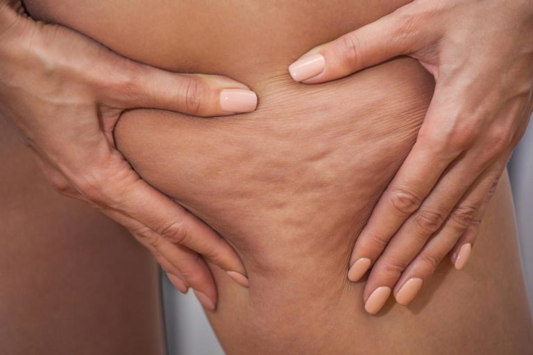 mejorar la celulitis